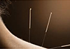 Thumbnail picture for Origin Acupuncture