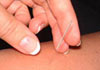 Thumbnail picture for Acupuncture Society